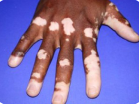 Bőrhibák – vitiligo