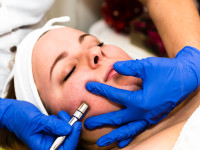 DermaPen MezoPen kezelés